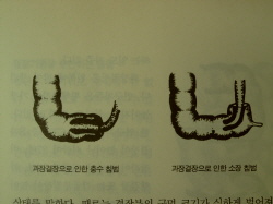 과장결장으로 인한 충수와 소장 침범. 늘어나고 확대된 과장결장이 숙변 침체의 근거지가 된다. 